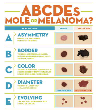 Diagram of how to determine if a spot is a melanoma or a mole by defining its ABCDEs. Asymmetry: Moles that have an asymmetrical appearance, Border: A mole that has blurry and/or jagged edges, Color: A mole that has more than one color, Diameter: Moles with a diameter larger than a pencil eraser (6 mm or 1/4 inch), and Evolution: A mole that has gone through changes in size, shape, or color